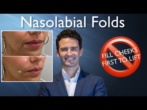 Understanding Nasolabial Fold Fillers: Benefits and Risks