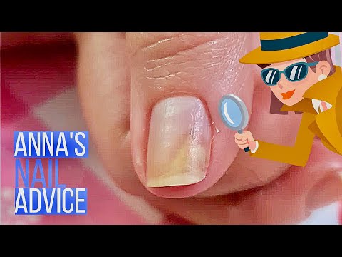 Onycholysis: Understanding Causes, Symptoms, and Treatments post thumbnail image