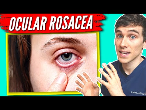 Ocular Rosacea: Symptoms, Causes, and Effective Treatments
