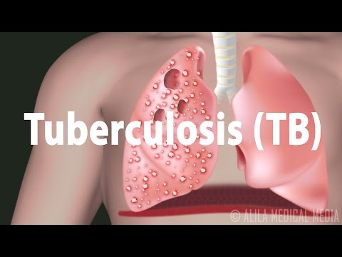 Miliary TB vs. Pulmonary: Key Differences in Diagnosis