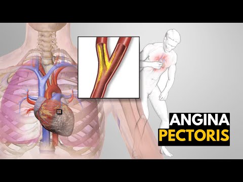 Understanding Stable Angina: Symptoms, Causes, and Care