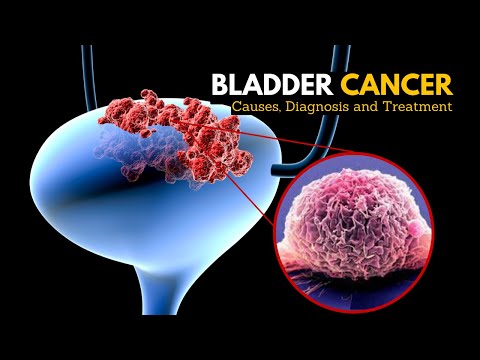 Understanding Transitional Cell Cancer: Symptoms and Treatments
