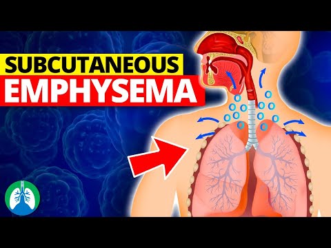 Understanding Subcutaneous Emphysema: Symptoms and Causes