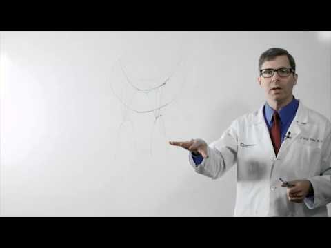 Understanding Mitral Valve Replacement: Procedure and Outlook