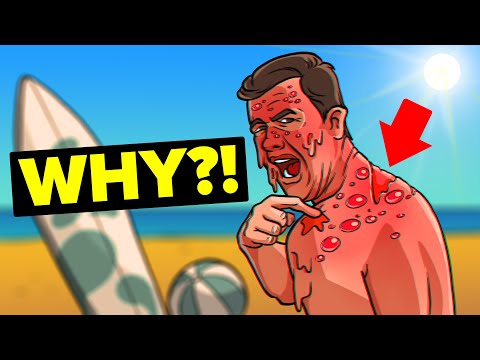 Understanding First-Degree Burns: Sunburn Symptoms and Care