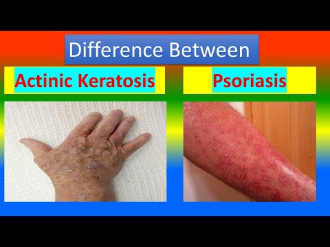 Understanding Actinic Keratosis, Moles, Nevus, and Psoriasis post thumbnail image
