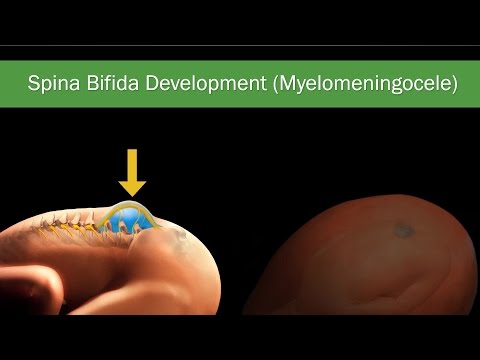 Understanding Meningocele Repair: Purpose, Procedure, and Recovery
