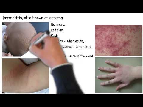 Dermatitis Herpetiformis vs. Eczema: What's the Difference?
