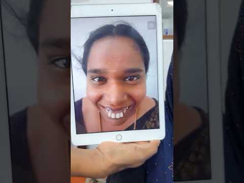 Transforming Smiles: Frenectomy Procedure and Recovery Journey