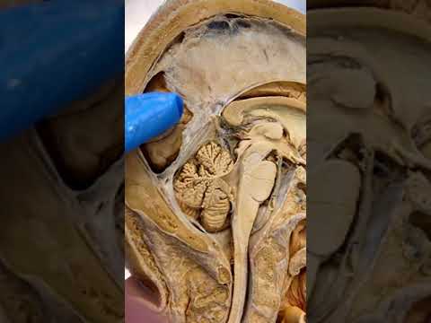 Understanding the Corpus Callosum: Key to Brain Health post thumbnail image