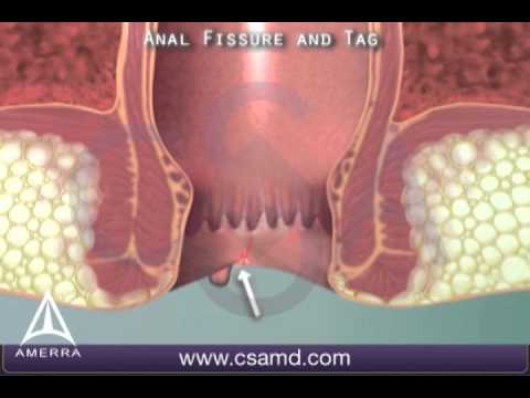 Understanding Anal Sphincter Function and Related Complications