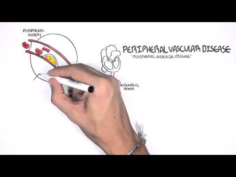 Understanding Cardiovascular Diseases: Types and Treatments