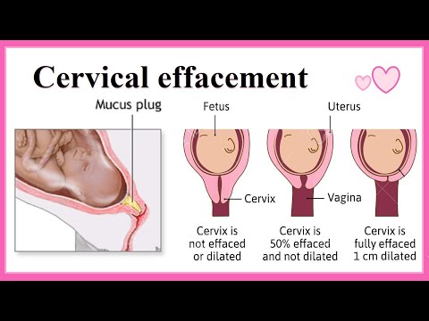 Understanding Cervical Effacement: Signs and Potential Risks post thumbnail image