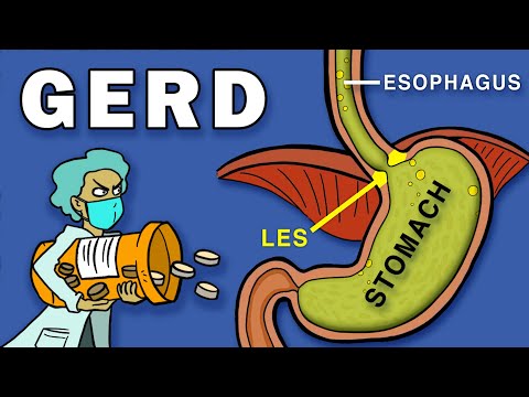Understanding GERD Symptoms: Cough, Chest Pain, and Nausea