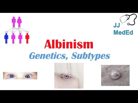 Understanding Ocular Albinism: Symptoms and Treatment Options