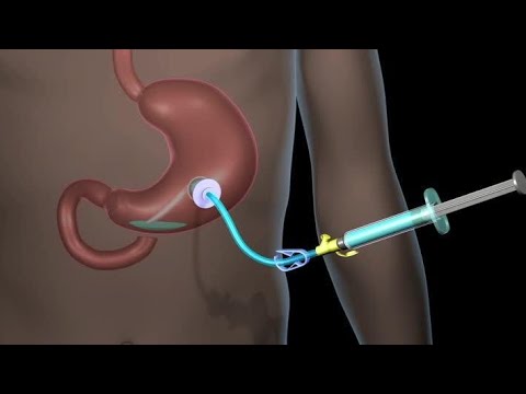 Understanding Feeding Tube Insertion: A Guide to Gastrostomy