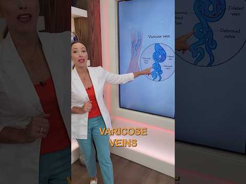 Effective Exercises to Relieve Varicose Vein Discomfort