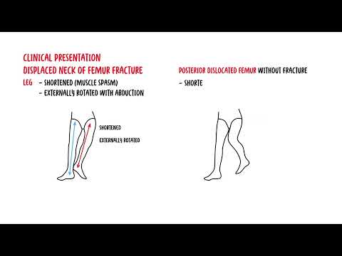 Understanding Femoral Neck Fracture: Treatments and Risks post thumbnail image