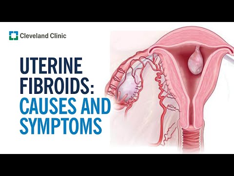 Understanding Uterine Fibroids: Causes, Treatments, and Care