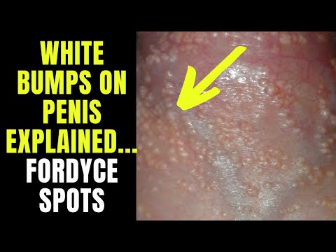 What You Should Know About Fordyce Spots on Foreskin