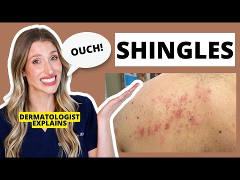 Understanding Myths and Facts About Shingles Symptoms and Care