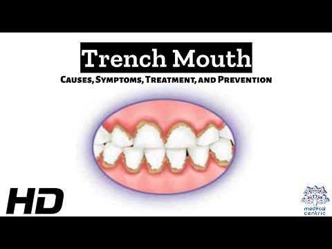 Trench Mouth: Understanding Causes, Symptoms, and Diagnosis post thumbnail image