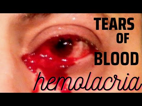 Understanding Haemolacria: Symptoms, Causes, and Solutions post thumbnail image
