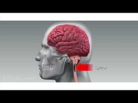 Understanding Arnold Chiari Malformation: Symptoms and Care