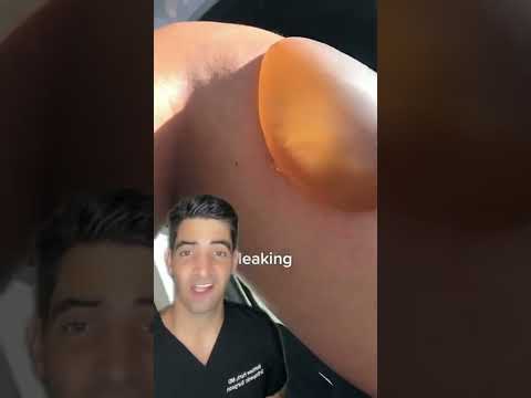 Should You Pop a Burn Blister? Essential Care Tips for Healing post thumbnail image