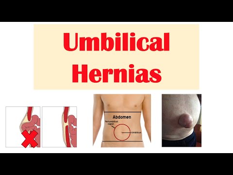 Understanding Umbilical Hernia: Causes, Symptoms, and Care