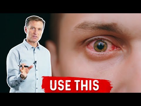 Effective Home Remedies to Banish Pinkeye Fast