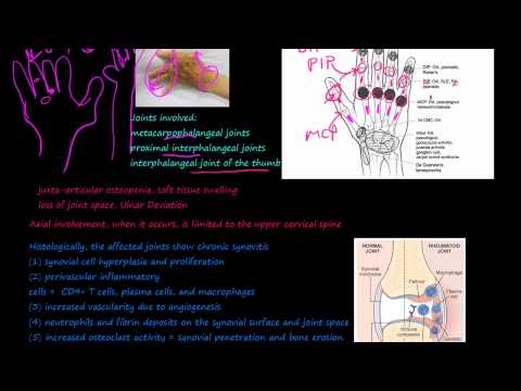Understanding Pannus in Rheumatoid Arthritis: What It Means
