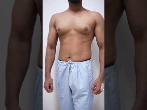 Shed Man Boobs Fast with This 5-Step Action Plan