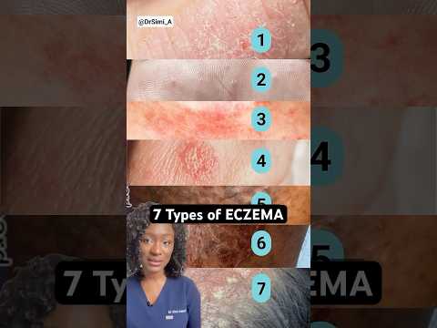 Understanding Discoid Eczema: Symptoms and Treatments Explained post thumbnail image