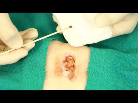 When to Cauterize a Wound and When It's Safe to Do So