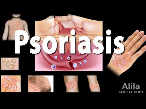 Understanding Treatment Options for Chronic Plaque Psoriasis