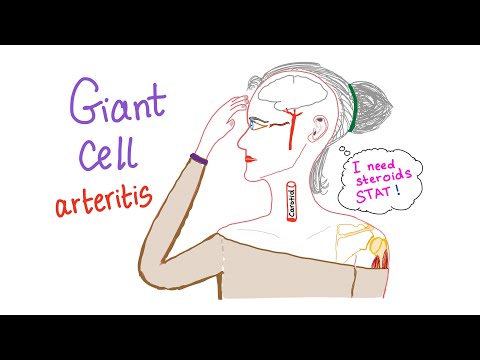 Understanding Temporal Arteritis: Symptoms and Treatments Explained