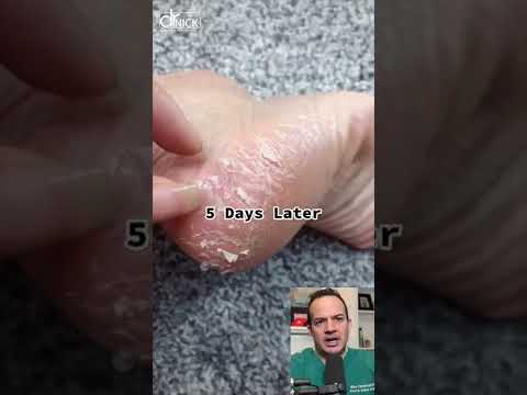 Understanding the Causes of Peeling Feet and Treatments