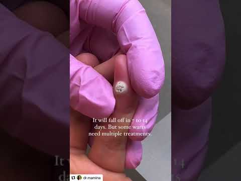 One-Step Wart Remover: Benefits and Possible Side Effects
