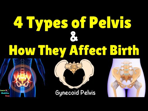 Understanding Pelvis Shapes: Their Impact on Birth Outcomes