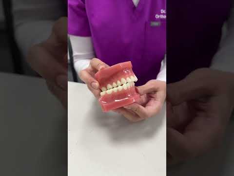 Understanding Crossbite: Causes and Effective Treatments