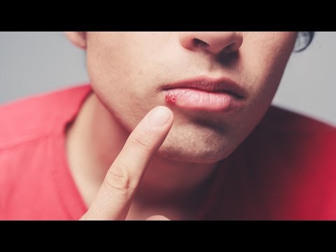 Bumps on Lips: What They Mean and How to Treat Them
