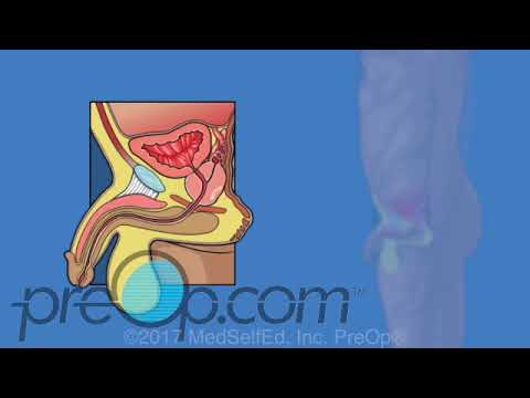 Understanding Transrectal Prostate Ultrasound and Biopsy post thumbnail image