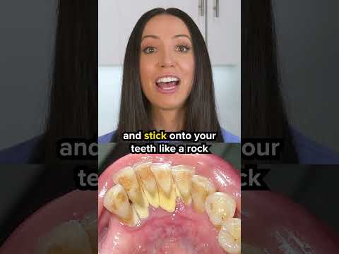 Understanding Black Tartar on Teeth: Causes and Removal Tips