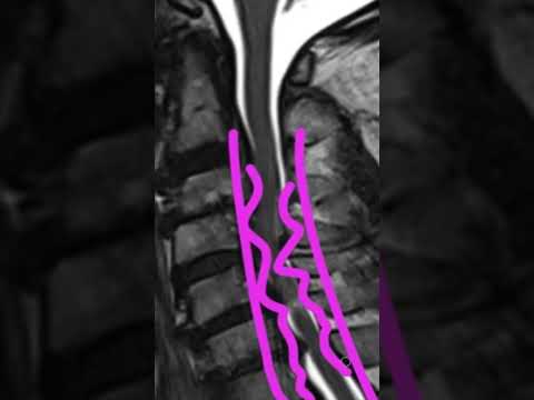 Understanding Spinal Osteoarthritis: Symptoms and Care Options