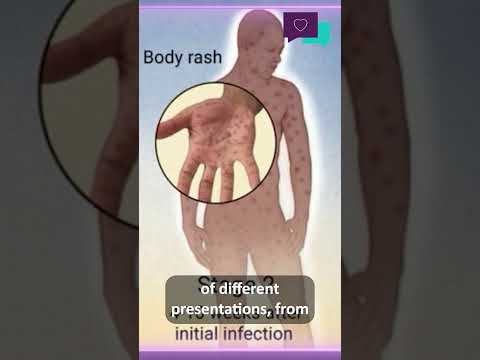 Understanding Syphilis Rash: Signs on Your Skin