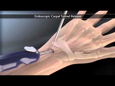Relief Awaits: Surgery for Carpal Tunnel Syndrome