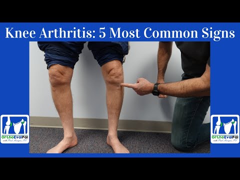 Osteoarthritis and Your Joints: Understanding the Impact