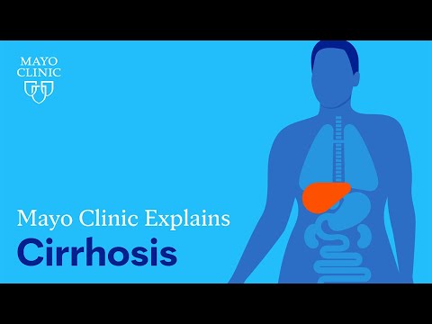 Understanding Decompensated Cirrhosis: Key Symptoms and Care