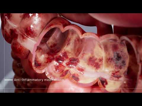 Understanding Uceris Oral: Uses, Side Effects, and Interactions post thumbnail image